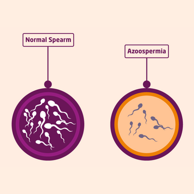 Apollo Homeopathy helps to cure azoospermia